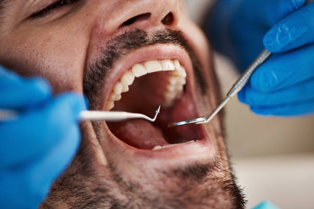 Best Emergency Dentist for Knocked-Out Tooth in Albemarle, NC